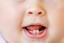 Diş Çıkaran Bebeklerin Emzirilmesinde Karşılaşılan Sorunlar